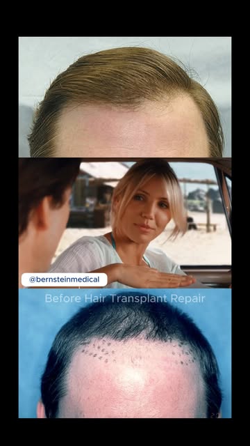 Are you with me? 😂 If you are, book a consultation.

#nyc #hairtransplant #hairsurgeon #HairRestora