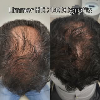 Natural results, real confidence.

This patient underwent an FUE (Follicular Unit Extraction) proced
