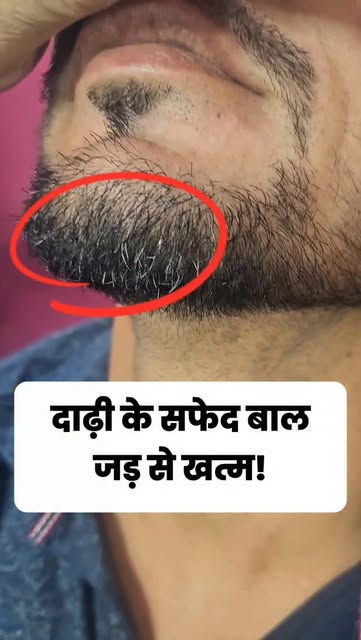 सफेद दाढ़ी से छुटकारा पाने का तरीका #drchhabra #whitebeard #electrolysis