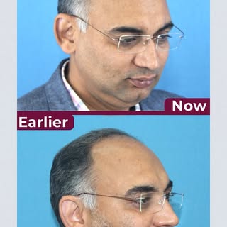 Hair loss isn’t always just about genetics. In some cases, nutritional deficiencies or underlying he