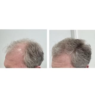 O tratamento clínico bem feito e@constante pode substituir ou retardar o transplante capilar.