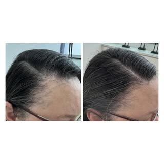 Alopecia Fibrosante Frontal é sempre um desafio mas com o tratamento adequado neste caso conseguimos