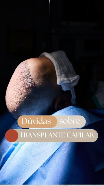 💬 Dúvidas sobre transplante capilar? Vamos esclarecer!

Recebo diariamente muitas perguntas sobre o