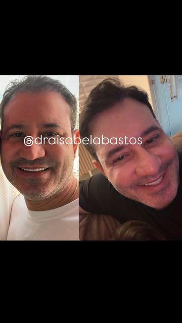 O sorriso de quem está aproveitando cada fio desse topete! 😂❤️

Após o transplante capilar, ver um 