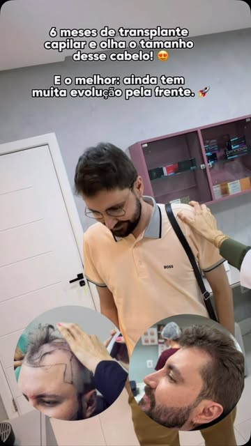 6 meses de transplante capilar e olha o tamanho desse cabelo! 

E o melhor: ainda tem muita evolução