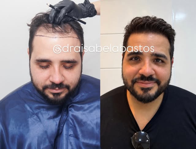 Mais do que preencher áreas com falhas, o transplante capilar é sobre devolver densidade, naturalida