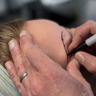 Fuller brows, natural results.
Eyebrow hair restoration is a great option for anyone experiencing th