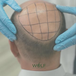 Every result starts with a plan.

This mapping process allows our team at Wolf Hair Restoration to d