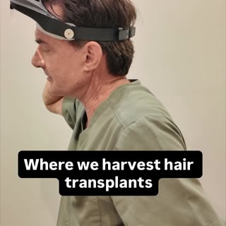 Dr Welden shows where the hair from a hair transplant comes from. #hair #menshealth #hairtransplant