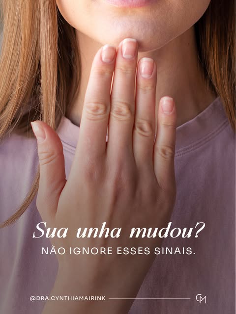 É muito comum alguém chegar ao consultório tratando uma alteração na unha como micose sem nunca ter 