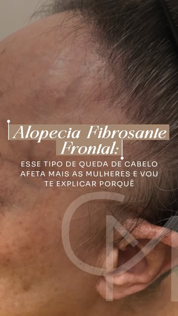 A alopecia fibrosante frontal é uma daquelas condições que começam de forma muito discreta. ⚠️

Muit