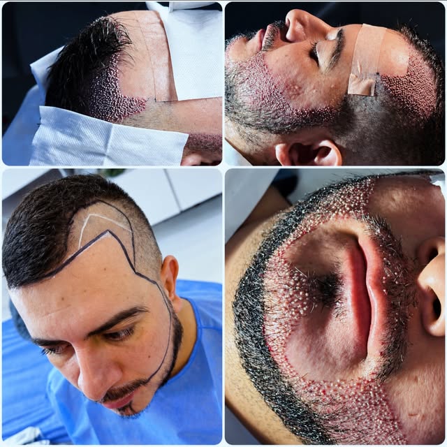 La energía de nuestros pacientes cuando finalizan su procedimiento menor no invasivo 

Hair and Face