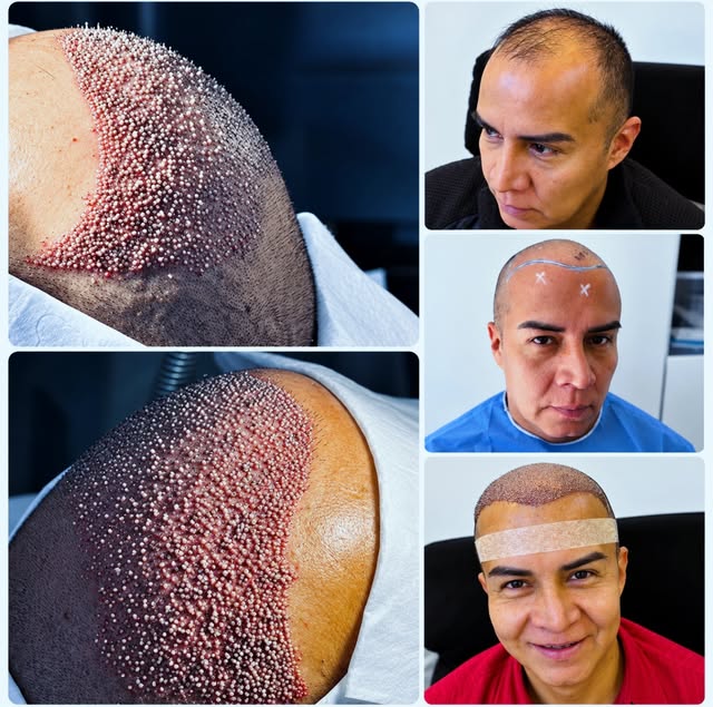 👨🏻‍⚕️Explora tu verdadero y renovado interior restaurando tu apariencia facial y capilar sin riesg