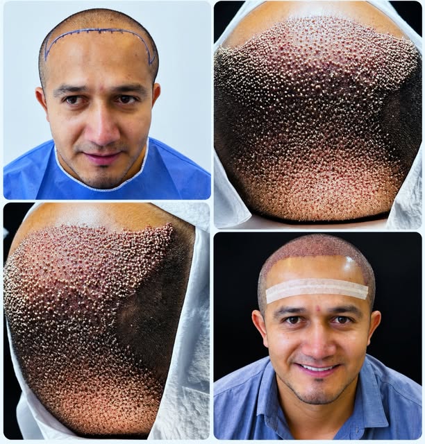 👨🏻‍⚕️Como parte inicial del protocolo Hair Forever y una restauración capilar completa y definitiv