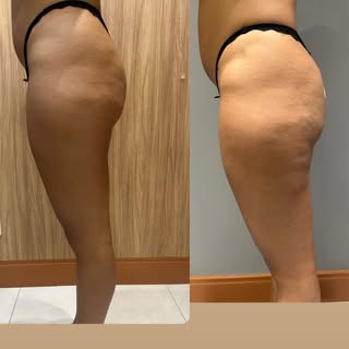Paciente perdeu peso usando Mounj@ro. Foram mais de 10kg, e a Harmonização Glútea foi a solução. O t