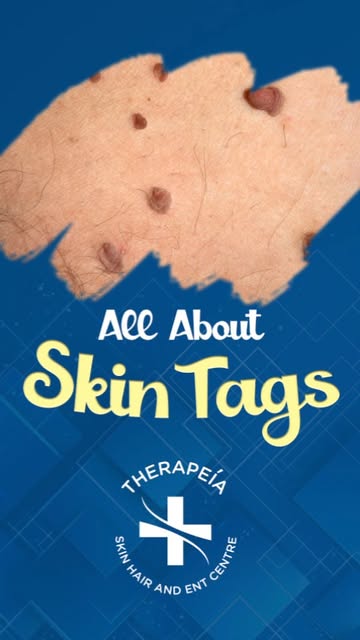 Did you know those tiny skin outgrowths called skin tags are mostly harmless?

Dr. Govind S Mittal, 