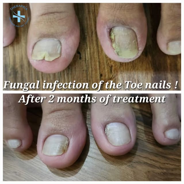 Ugly infected nails can be a great put off! And if this is due to a Fungal infection of the nails,  