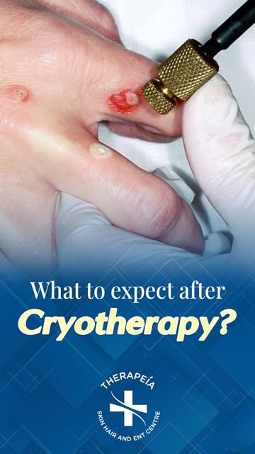 Wondering what to expect after treating your viral wart with cryotherapy? Dr. Govind S. Mittal, a bo