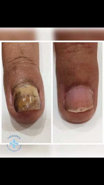 Treating nail infections can be tough! Especially when you are getting ready for your special day!