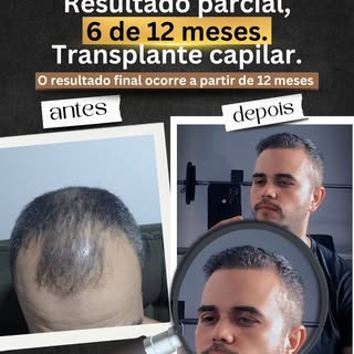 ransformação em andamento  e já impressionante.
Este é o resultado parcial de um transplante capilar
