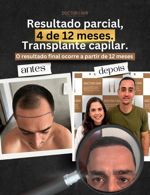 ransformação em andamento  e já impressionante.
Este é o resultado parcial de um transplante capilar