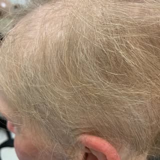Our lovely client has a form of scarring alopecia and was looking for a solution that would be able 