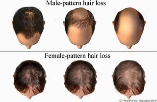 You know what day it is! This weeks topic for Trichology Tuesday is Androgenetic Alopecia!

Androgen