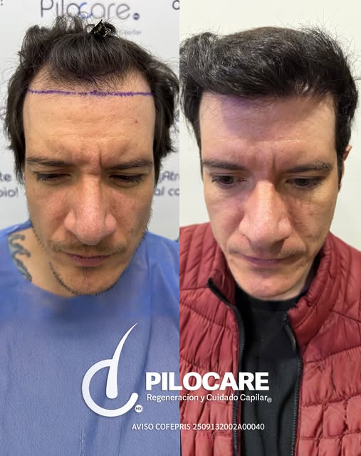 Regeneración Frontal, Hair Line y Entradas
Diagnóstico: AAG
🌾 Unidades Foliculares: 2,200
💇‍♂️ Cab