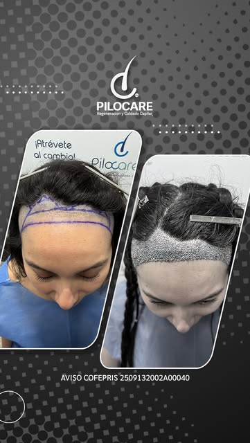 💉 Procedimiento: Regeneración capilar frontal con técnica FUE

🌱 2,123 unidades foliculares implan