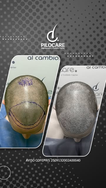🧬 Diagnóstico: AAG III A
💉 Procedimiento: Regeneración capilar frontal y coronilla con técnica FUE