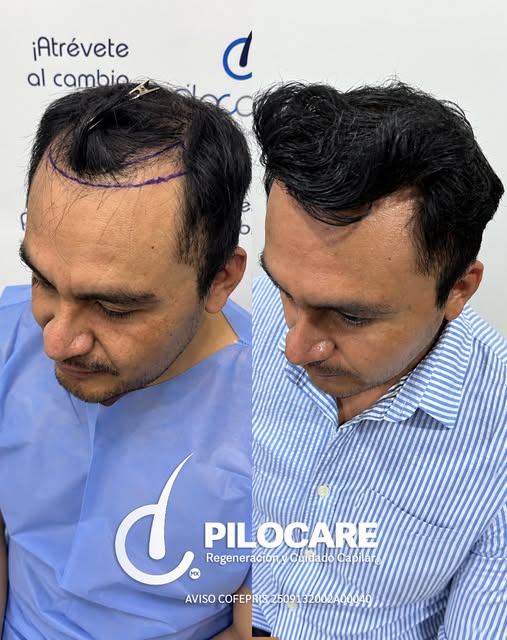 Regeneración Frontal y Coronilla
🧬 Diagnóstico: AAG Grado IV
🌾 Unidades Foliculares: 2,500
💇‍♂️ C