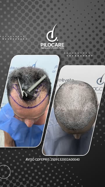 🧬 Diagnóstico: AAG III Vertex
💉 Procedimiento: Regeneración capilar frontal y coronilla con técnic