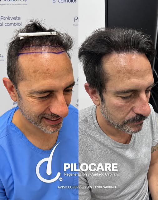 Regeneración Frontal, Hair Line y Entradas
🧬 Diagnóstico: AAG III Difuso + Injerto Previo
🌾 Unidad