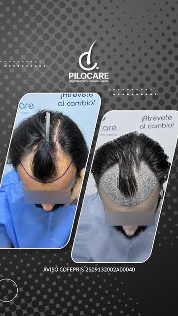 🧬 Diagnóstico: AAG III
💉 Procedimiento: Regeneración frontal, Hairline y Entradas con técnica FUE
