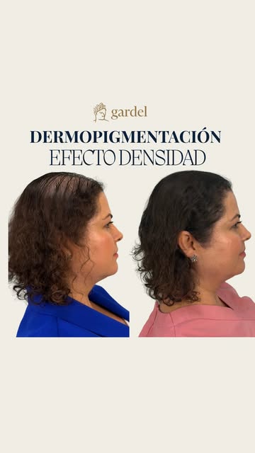 ¿Sabías que la dermopigmentación capilar también es para mujeres? 👩🏻
Si tu cabello ha perdido dens