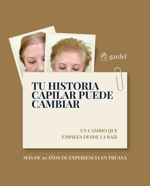 ¿Has notado una disminución en la densidad de tu cabello?
El trasplante capilar puede ser una altern