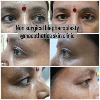 Non surgical Blepharoplasty #balewadihighstreet😋✌🏻️ #baner #banerskinclinic #dermatology #cosmetol