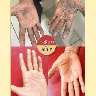 खुजली, पपड़ी और फटी हथेलियों को सिर्फ “सूखापन” समझकर नज़रअंदाज़ न करें! 🖐️
सही diagnosis और dermato