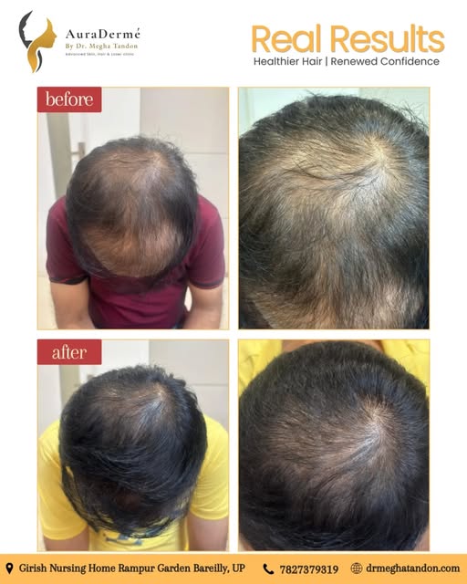 Visible, real results that speak for themselves. ✨

​Witness this incredible hair regrowth transform