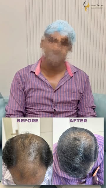 Hair loss ke saath sabse pehle hairline nahi, daily confidence kam hone lagta hai.

​Recently, ek pa