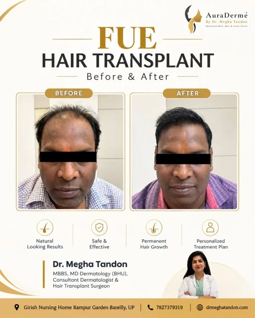 Real results speak louder than words. ✨

​Swipe to see this incredible hair restoration journey with