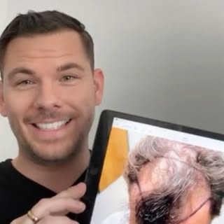 Tyler’s 4 month update after his Multi-Unit Hair Grafting™ Hair Transplant! Do you want to get your 
