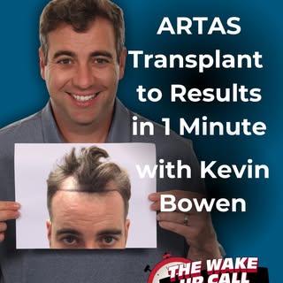 Kevin has shared every step of his ARTAS Robotic FUE hair transplant journey with us and we’re shari