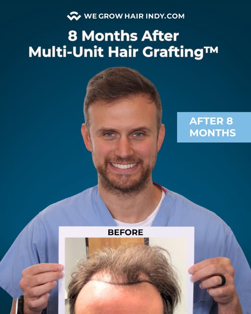 We restored Kevin’s frontal third using our signature Multi-Unit Hair Grafting™ procedure, bringing 