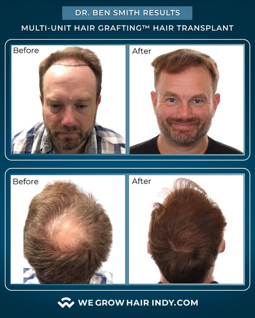 Complete coverage from the hairline to the crown.⁠
⁠
Take a look at these results for Dr. Ben Smith 
