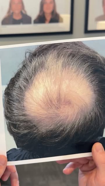 From a completely exposed crown to full, dense coverage—Tyran’s 12-month results speak for themselve