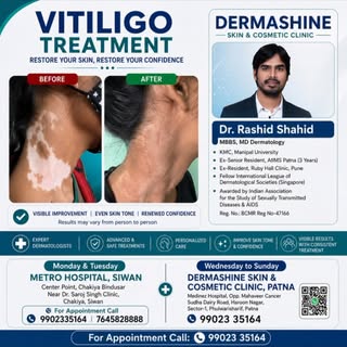 Vitiligo treatment- Medicine, Surgery, Laser #vitiligo #safeddaag #safeddaagtreatment #vitiligoaware