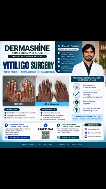 For Vitiligo Treatment / Surgery, consult Dr Rashid Shahid, MBBS, MD Dermatologist #vitiligo #vitili