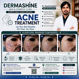 For Acne treatment, Consult Dr Rashid Shahid , 9902335164