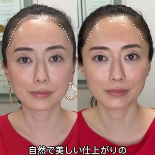 ヘアラインアートメイク＝毛並みと思っていませんか？🤔

実は、生え際のお悩みによって最適な技法は変わります。

今回のモデル様は、髪は生えているものの、生え際の透け感がお悩みでした。

このようなケ